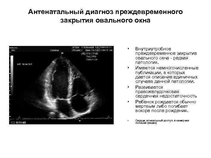 Антенатальный диагноз преждевременного закрытия овального окна • • • Внутриутробное преждевременное закрытие овального окна