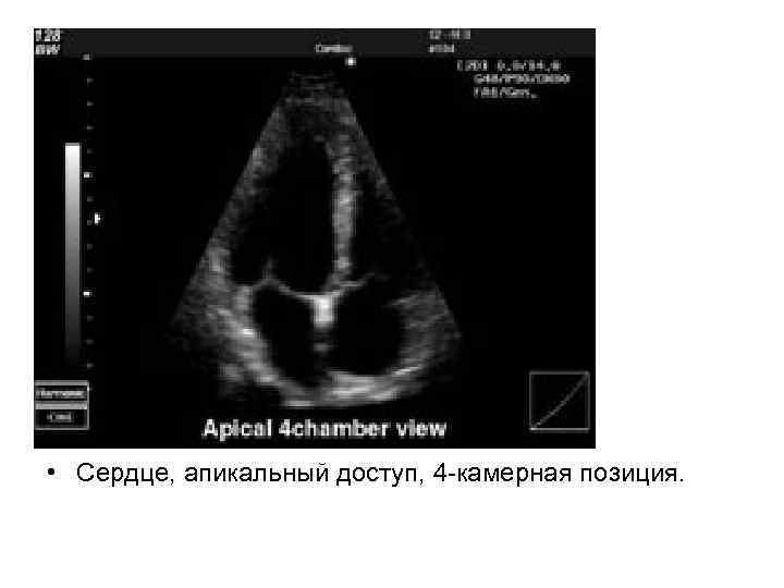  • Сердце, апикальный доступ, 4 -камерная позиция. 