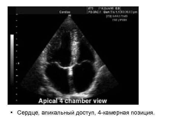  • Сердце, апикальный доступ, 4 -камерная позиция. 