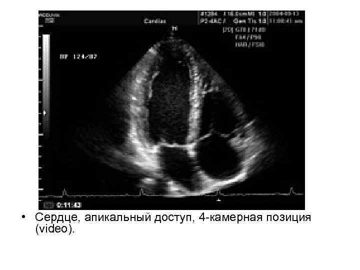  • Сердце, апикальный доступ, 4 -камерная позиция (videо). 