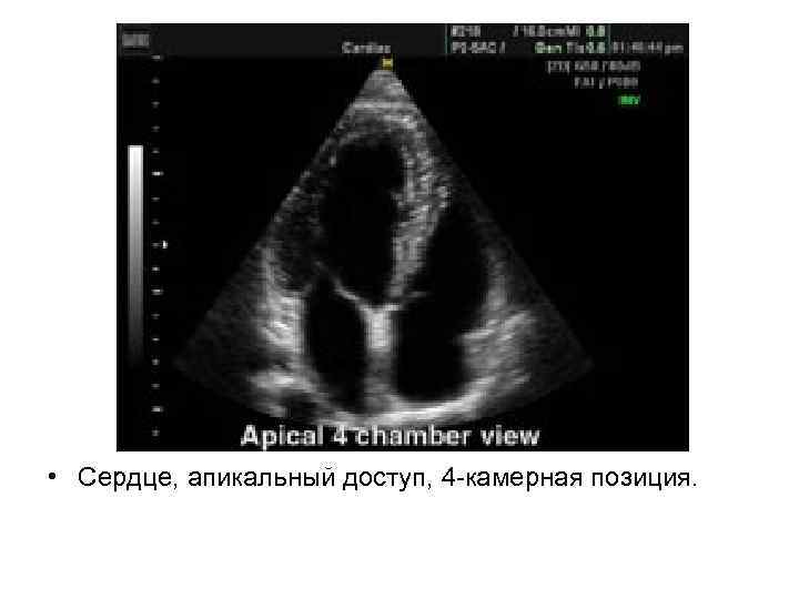  • Сердце, апикальный доступ, 4 -камерная позиция. 