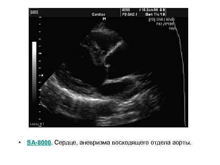  • SA-8000. Сердце, аневризма восходящего отдела аорты. 