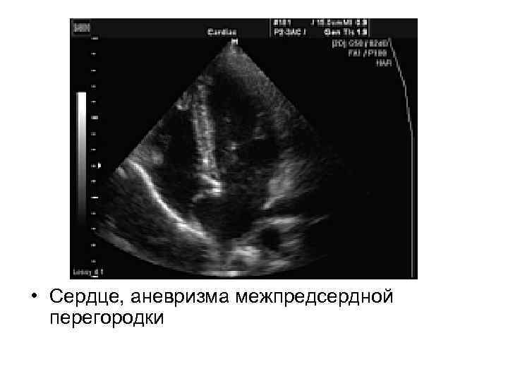  • Сердце, аневризма межпредсердной перегородки 