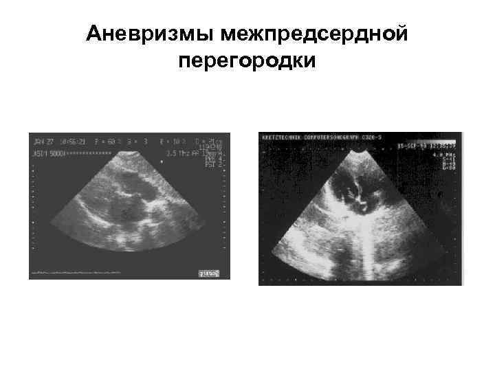 Аневризмы межпредсердной перегородки 