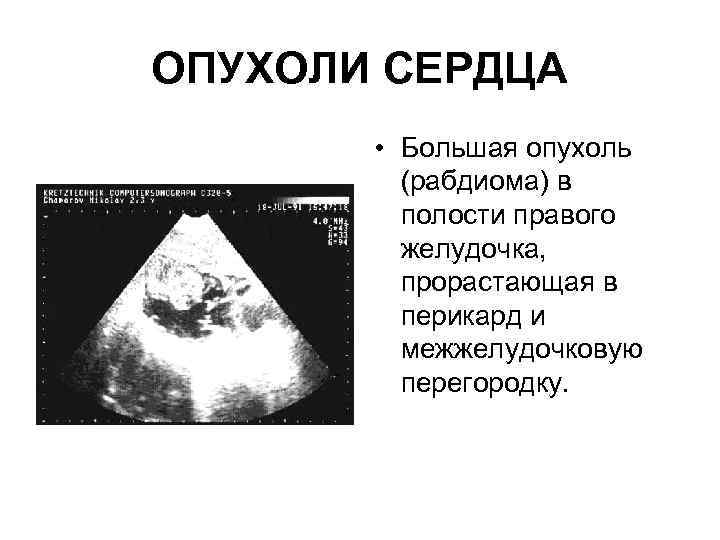 ОПУХОЛИ СЕРДЦА • Большая опухоль (рабдиома) в полости правого желудочка, прорастающая в перикард и