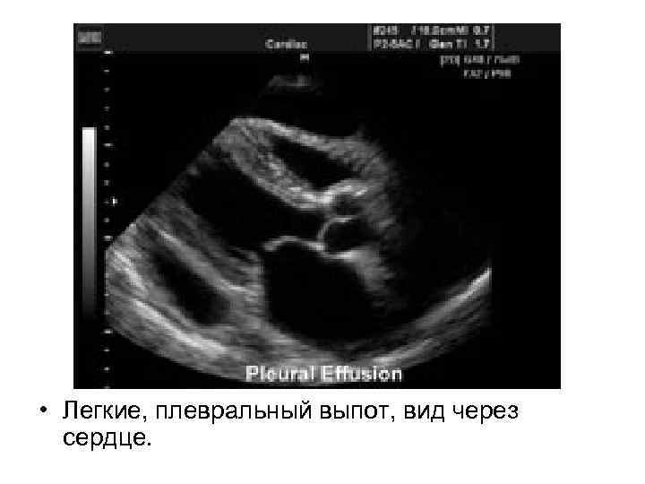  • Легкие, плевральный выпот, вид через сердце. 