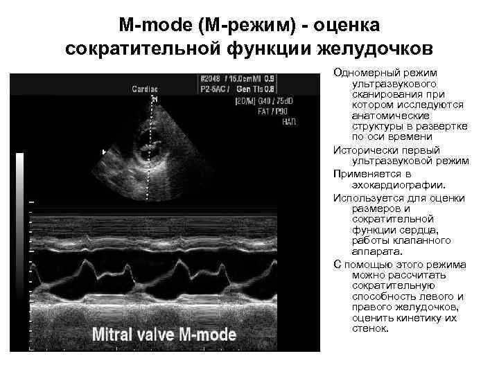 M-mode (M-режим) - оценка сократительной функции желудочков Одномерный режим ультразвукового сканирования при котором исследуются