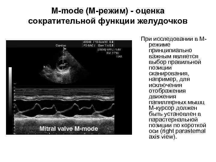 M-mode (M-режим) - оценка сократительной функции желудочков При исследовании в Мрежиме принципиально важным является