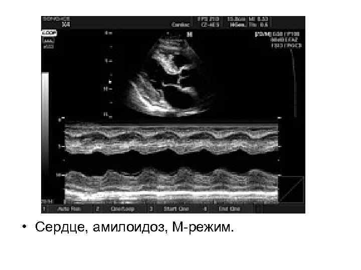  • Сердце, амилоидоз, М-режим. 
