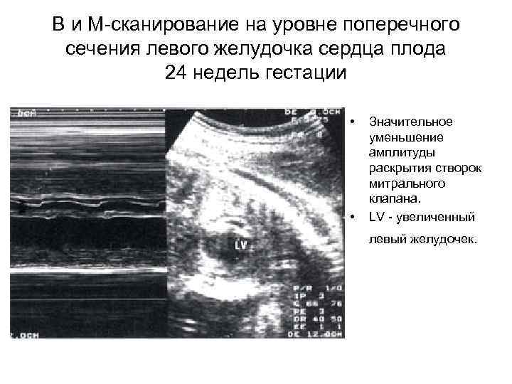 В и М-сканирование на уровне поперечного сечения левого желудочка сердца плода 24 недель гестации