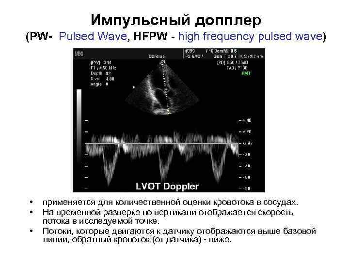 Импульсный допплер (PW- Pulsed Wave, HFPW - high frequency pulsed wave) • • •