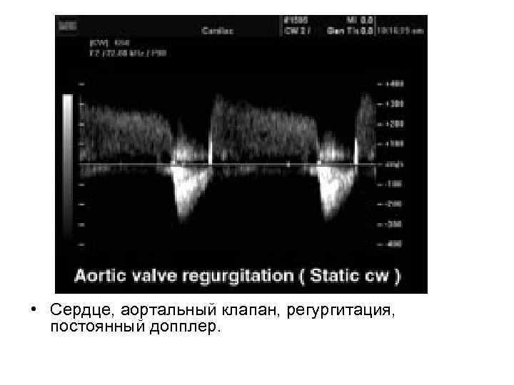  • Сердце, аортальный клапан, регургитация, постоянный допплер. 