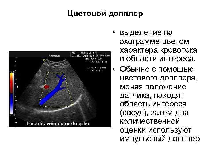 Цветовой допплер • выделение на эхограмме цветом характера кровотока в области интереса. • Обычно