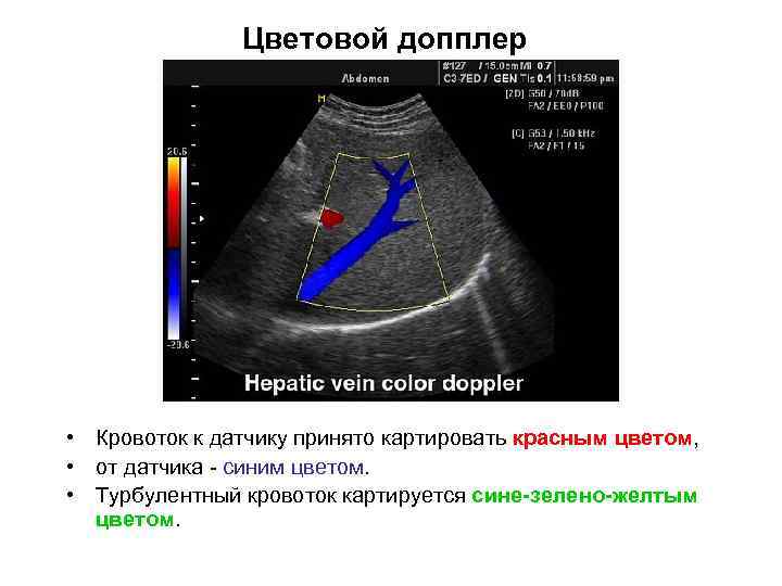 Цветовой допплер • Кровоток к датчику принято картировать красным цветом, • от датчика -