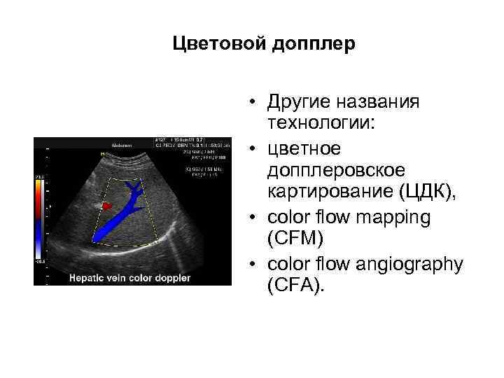 Цветовой допплер • Другие названия технологии: • цветное допплеровское картирование (ЦДК), • color flow