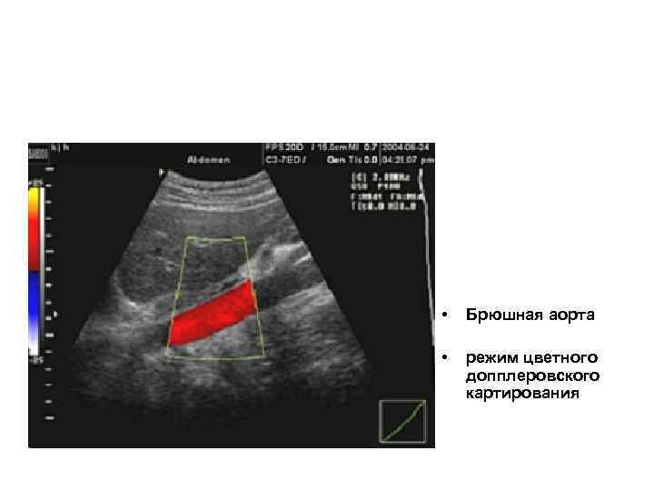  • Брюшная аорта • режим цветного допплеровского картирования 