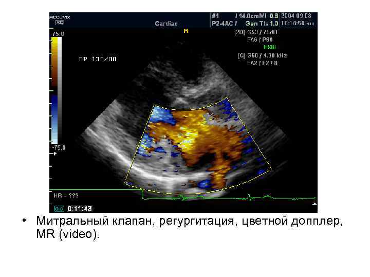  • Митральный клапан, регургитация, цветной допплер, MR (videо). 