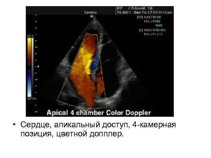  • Сердце, апикальный доступ, 4 -камерная позиция, цветной допплер. 