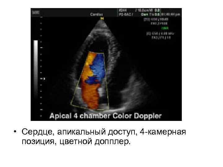  • Сердце, апикальный доступ, 4 -камерная позиция, цветной допплер. 