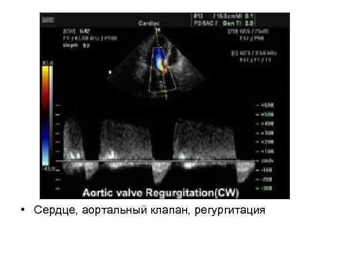 • Сердце, аортальный клапан, регургитация 