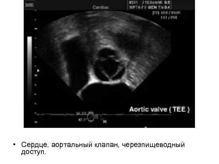  • Сердце, аортальный клапан, черезпищеводный доступ. 
