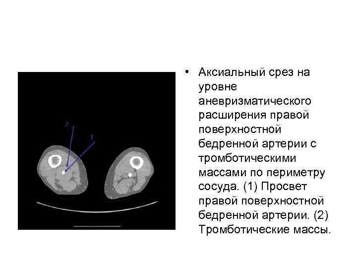  • Аксиальный срез на уровне аневризматического расширения правой поверхностной бедренной артерии с тромботическими