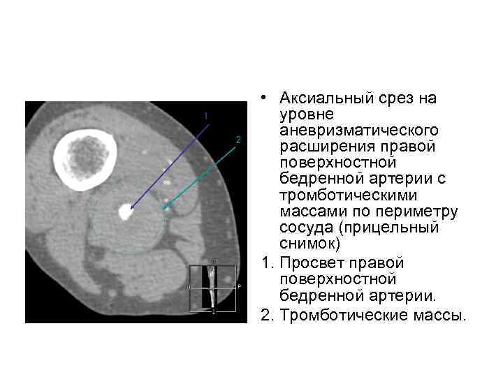  • Аксиальный срез на уровне аневризматического расширения правой поверхностной бедренной артерии с тромботическими
