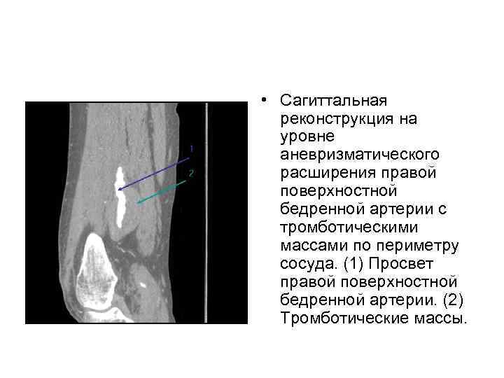  • Сагиттальная реконструкция на уровне аневризматического расширения правой поверхностной бедренной артерии с тромботическими