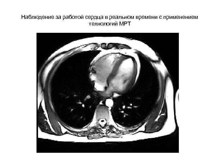 Наблюдение за работой сердца в реальном времени с применением технологий МРТ 