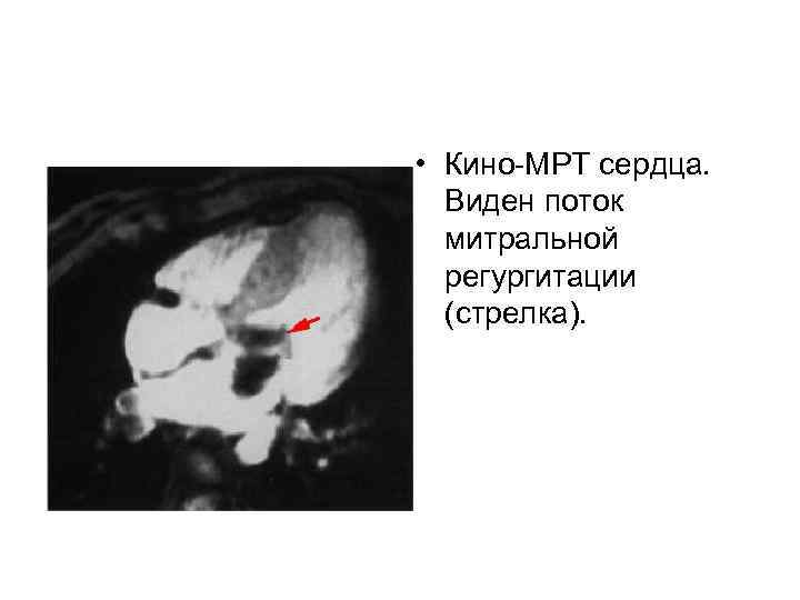  • Кино-МРТ сердца. Виден поток митральной регургитации (стрелка). 