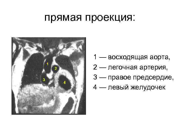прямая проекция: 1 — восходящая аорта, 2 — легочная артерия, 3 — правое предсердие,