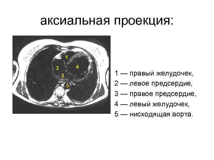 1 левый желудочек 2 левое предсердие