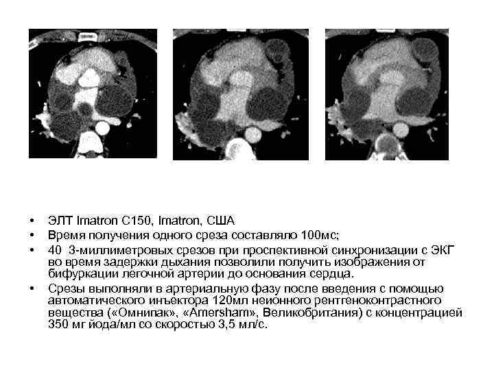 • • ЭЛТ Imatron C 150, Imatron, США Время получения одного среза составляло