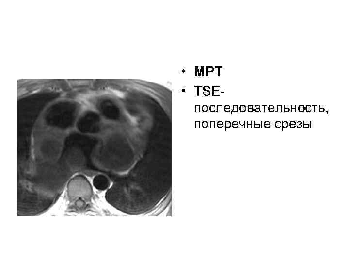  • МРТ • TSEпоследовательность, поперечные срезы 