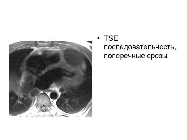  • TSEпоследовательность, поперечные срезы 