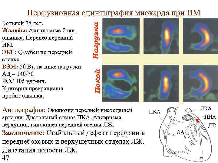 Покой Больной 78 лет. Жалобы: Ангинозные боли, одышка. Перенес передний ИМ. ЭКГ: Q-зубец по