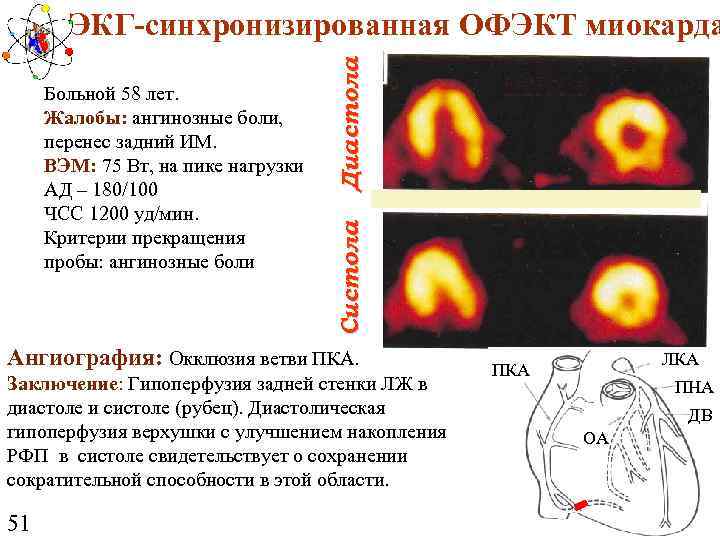 Систола Больной 58 лет. Жалобы: ангинозные боли, перенес задний ИМ. ВЭМ: 75 Вт, на