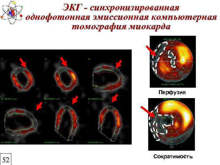 ЭКГ - синхронизированная однофотонная эмиссионная компьютерная томография миокарда Перфузия 52 Сократимость 