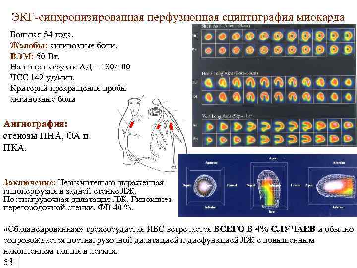 Презентация сцинтиграфия миокарда