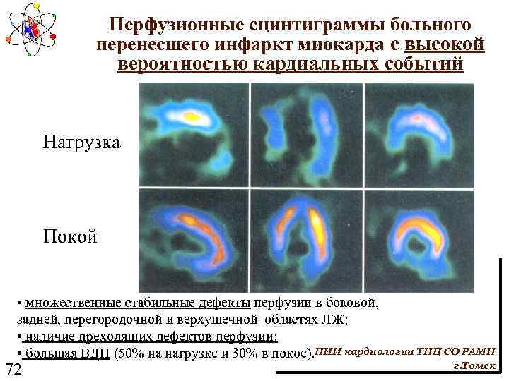 Перфузионные сцинтиграммы больного перенесшего инфаркт миокарда с высокой вероятностью кардиальных событий Нагрузка Покой •