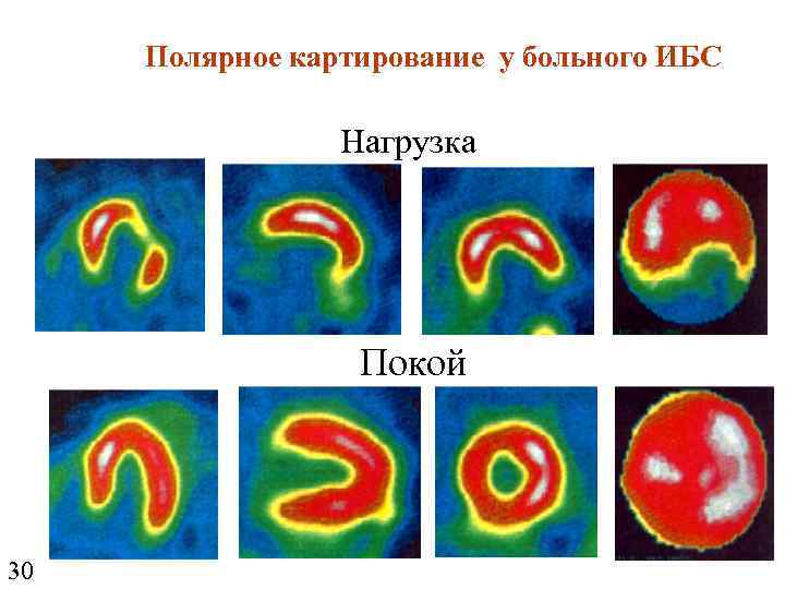 Полярное картирование у больного ИБС Нагрузка Покой 30 