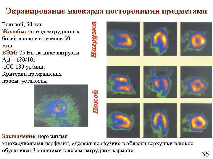 Покой Больной, 50 лет Жалобы: эпизод загрудинных болей в покое в течение 30 мин.
