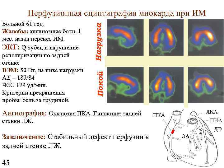 Покой Больной 61 год. Жалобы: ангинозные боли. 1 мес. назад перенес ИМ. ЭКГ: Q-зубец