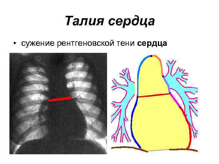 Талия сердца • сужение рентгеновской тени сердца 