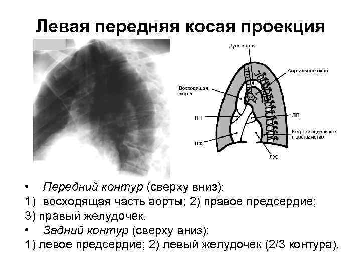 Левая передняя косая проекция • Передний контур (сверху вниз): 1) восходящая часть аорты; 2)