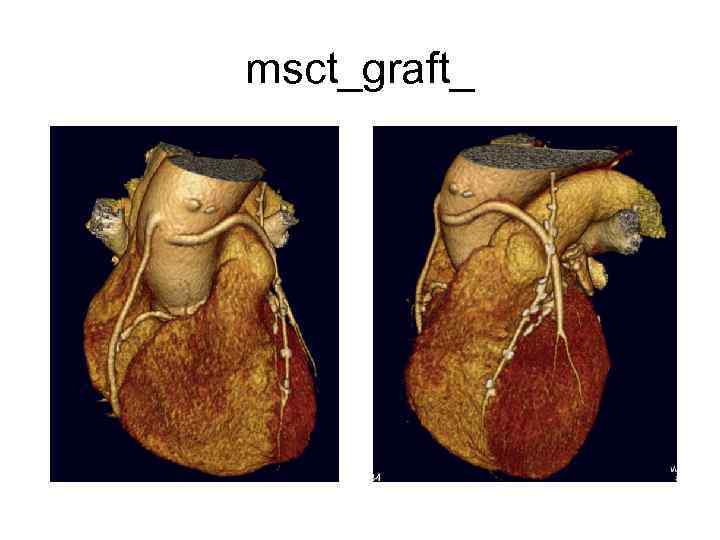 msct_graft_ 