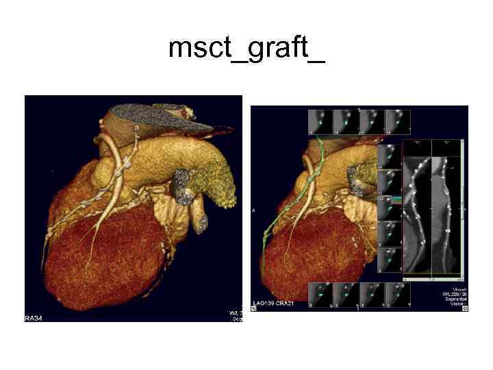 msct_graft_ 