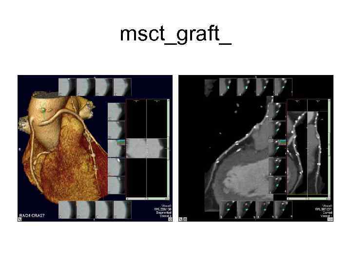 msct_graft_ 