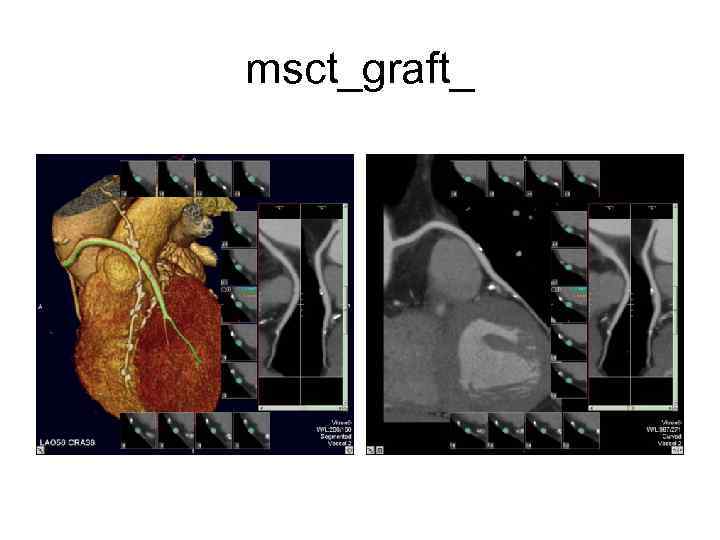 msct_graft_ 