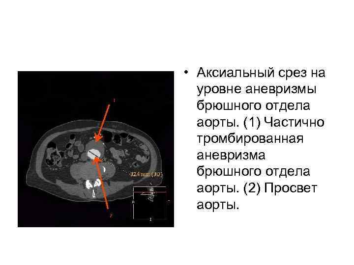  • Аксиальный срез на уровне аневризмы брюшного отдела аорты. (1) Частично тромбированная аневризма
